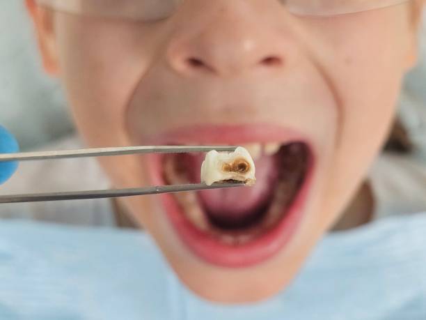 Best Emergency Treatment for Dental Infections or Abscesses in Auxvasse, MO